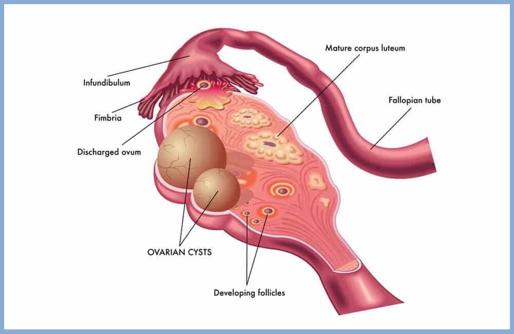 Kystes ovariens et grossesse, comment influencent-ils la fertilité ...