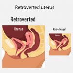 What is a Retroverted Uterus