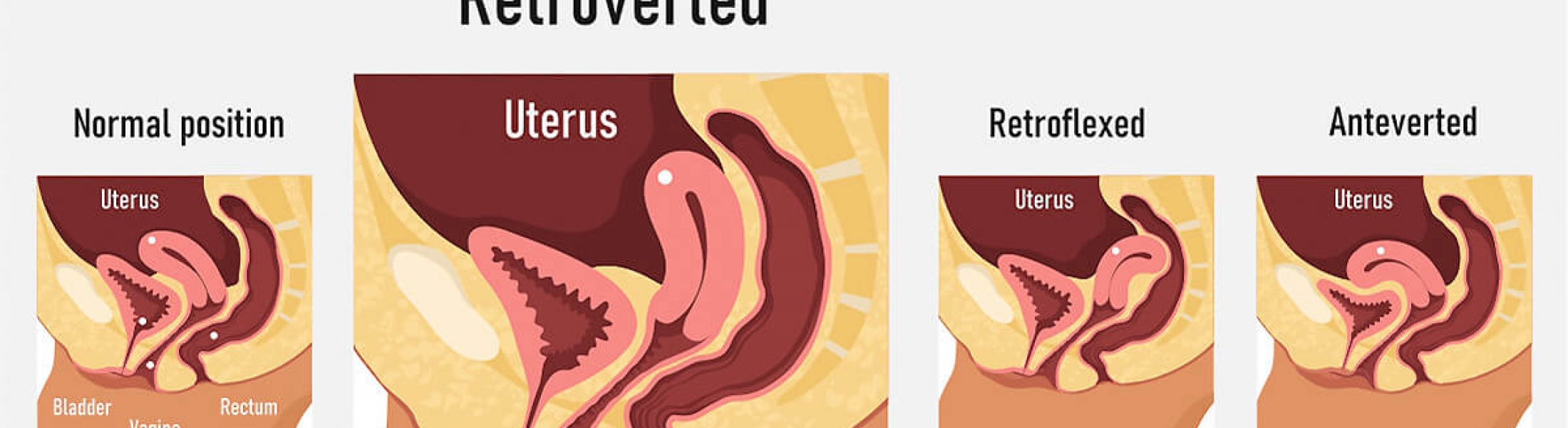 Ut Rus R Trovers Sympt Mes Et Traitements De La Fertilit Fertilab